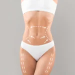 Female patient with surgical markings on the abdomen and thighs for liposuction UK.