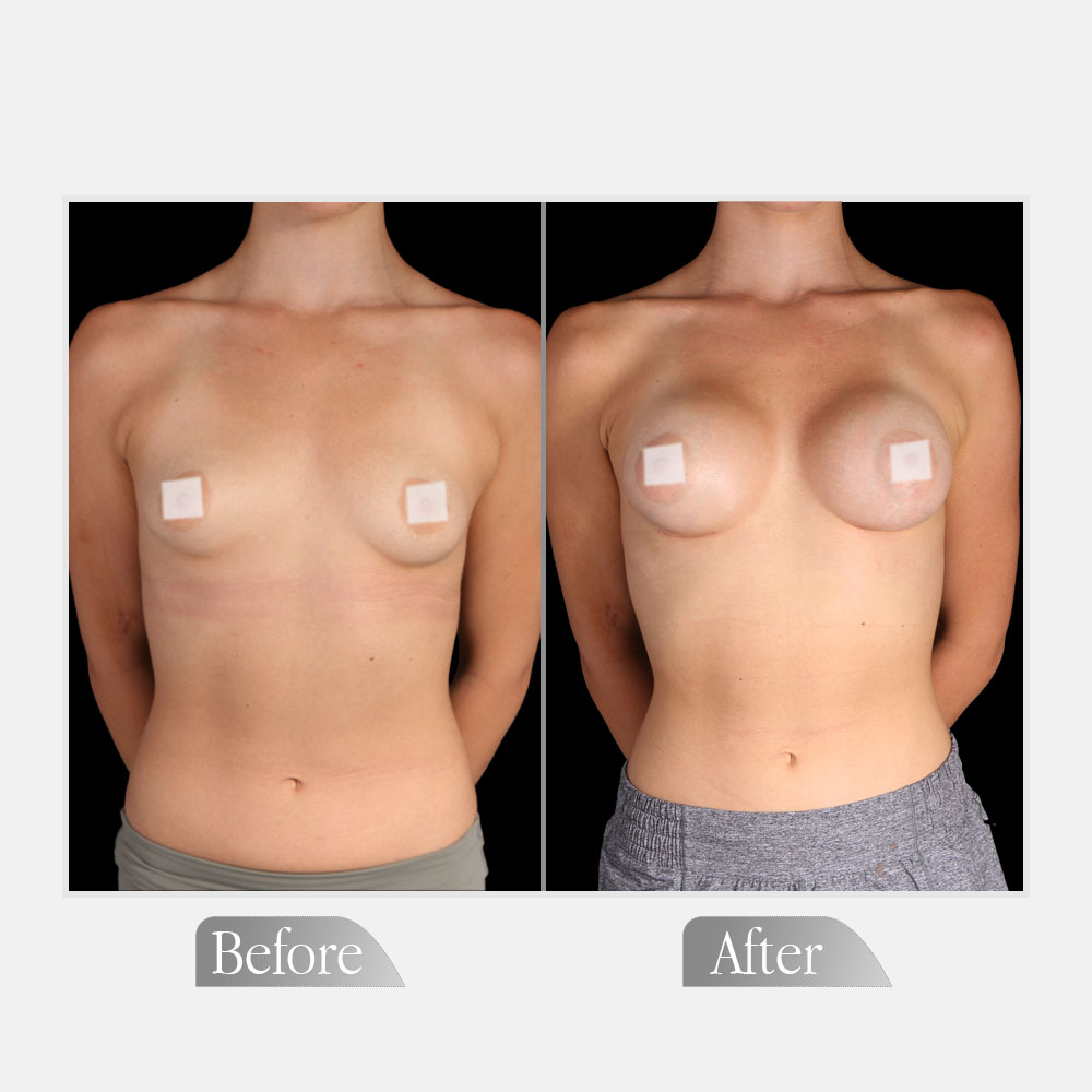 Preoperative and postoperative comparison of oblique contours following bilateral augmentation mammaplasty for Breast Surgery in UK.