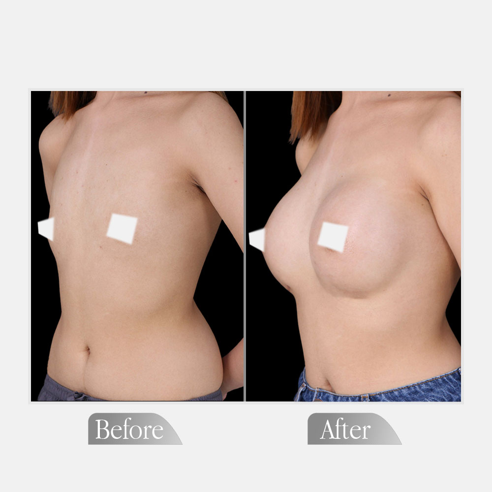 Postoperative comparative visualization of volumetric and morphological changes following bilateral augmentation mammaplasty for Breast Surgery in UK.
