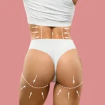 A back view of a woman from the waist down wearing white undergarments against a pink background, with white dashed lines and directional arrows drawn on her lower back and under the buttocks to plan for Butt Augmentation in UK.