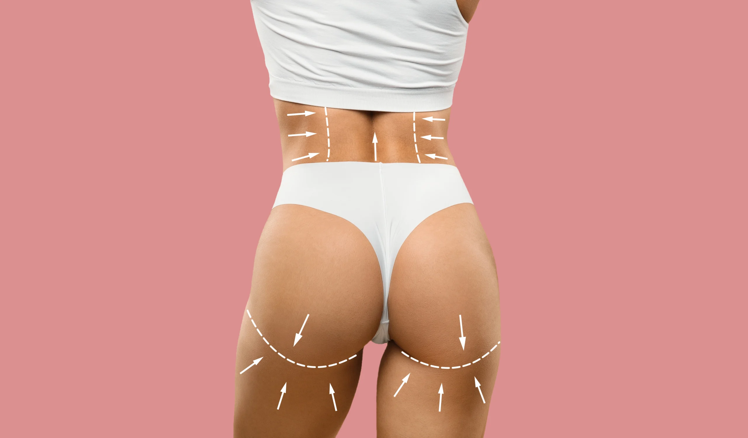 A back view of a woman from the waist down wearing white undergarments against a pink background, with white dashed lines and directional arrows drawn on her lower back and under the buttocks to plan for Butt Augmentation in UK.
