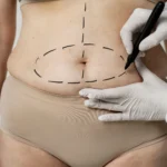 A close-up view of a surgeon wearing white gloves drawing a dashed black oval around a patient's lower abdomen to map out adipose tissue for a comparative guide on the Different Types of Liposuction IN UK.