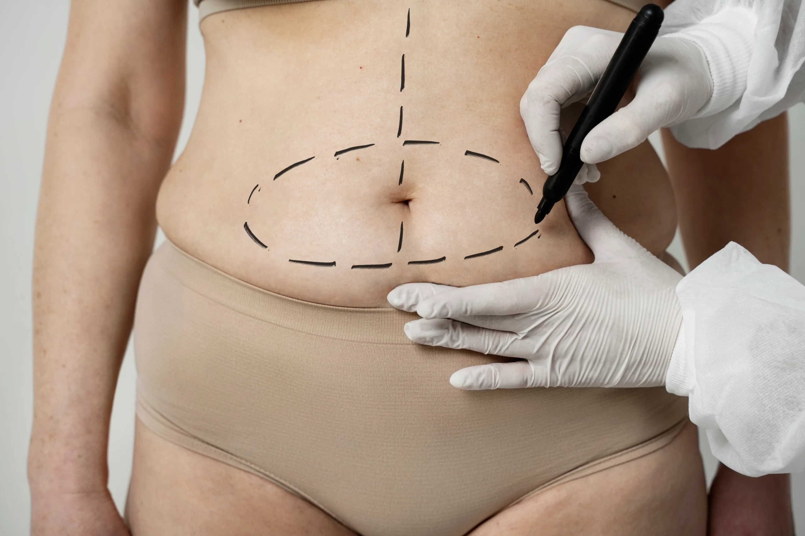 A close-up view of a surgeon wearing white gloves drawing a dashed black oval around a patient's lower abdomen to map out adipose tissue for a comparative guide on the Different Types of Liposuction IN UK.