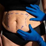 A posterior view of a woman's torso and upper thighs in white underwear against a pink background, featuring white dashed planning lines and directional arrows to map out localized fat extraction for an instructive guide to Understand 360 Liposuction Recovery Day By Day In UK.