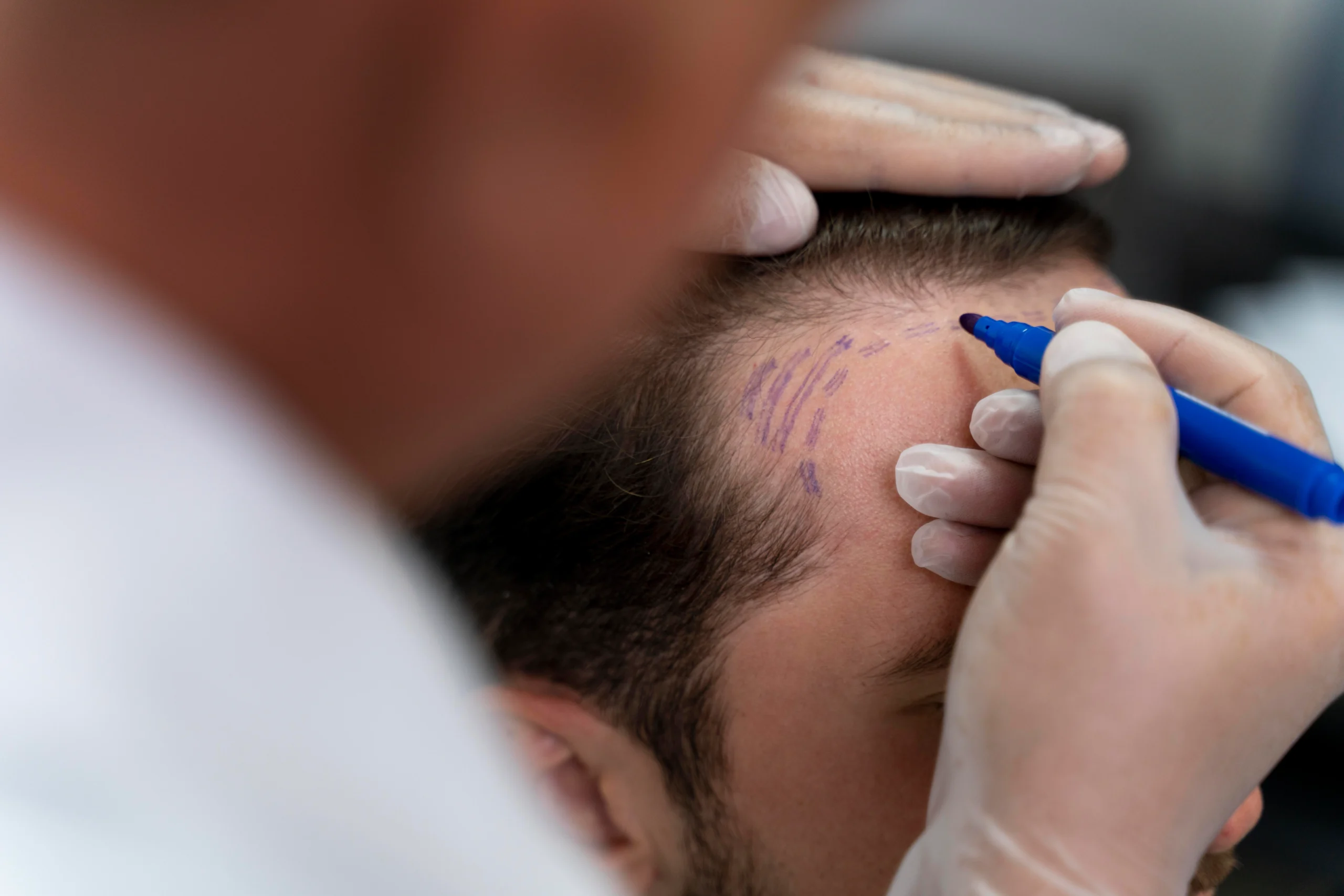 Surgeon performing clinical marking of the frontal hairline for a follicular unit extraction hair transplant UK.