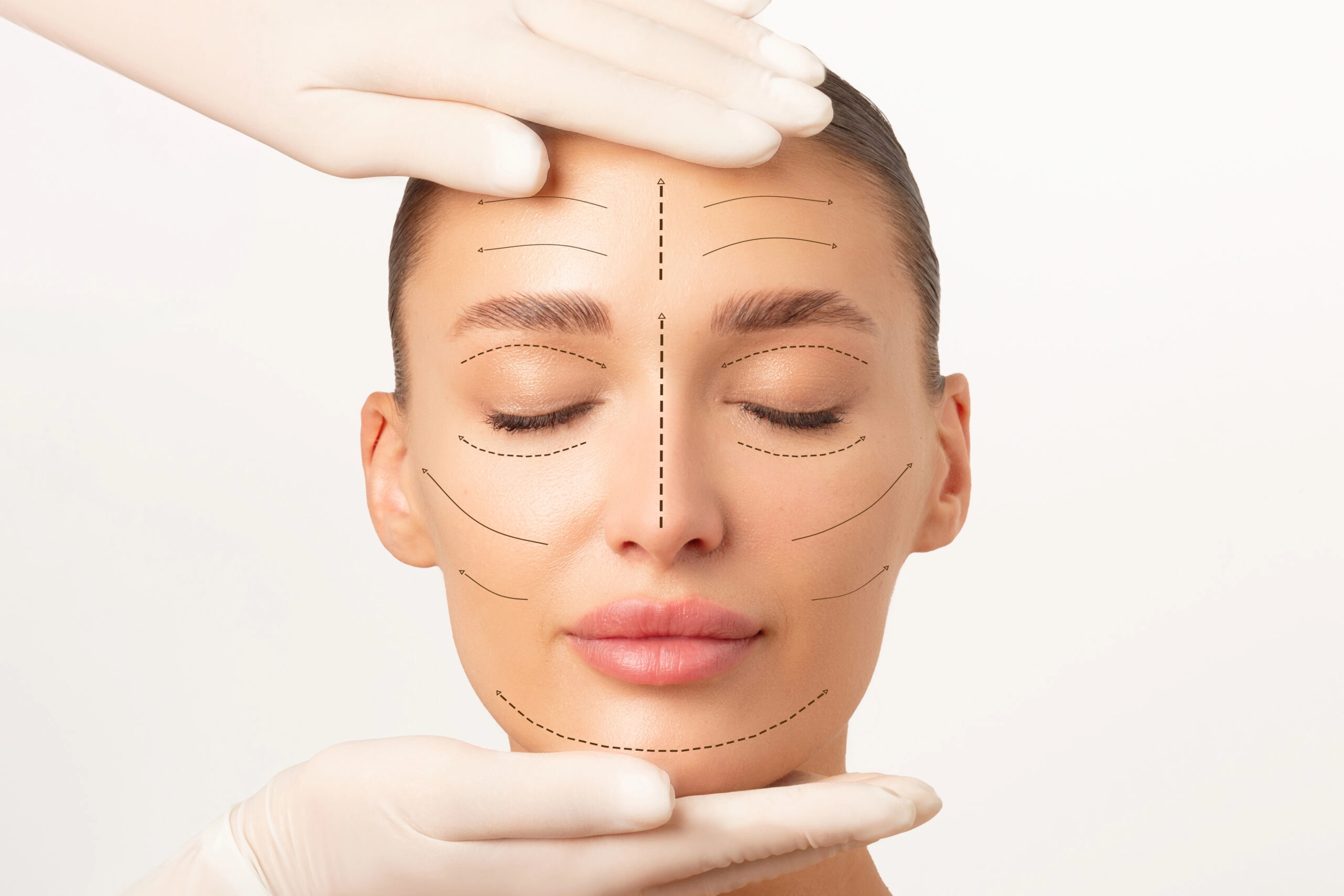 Clinical illustration of facial surgical vectors and incision lines for an Face lift UK.