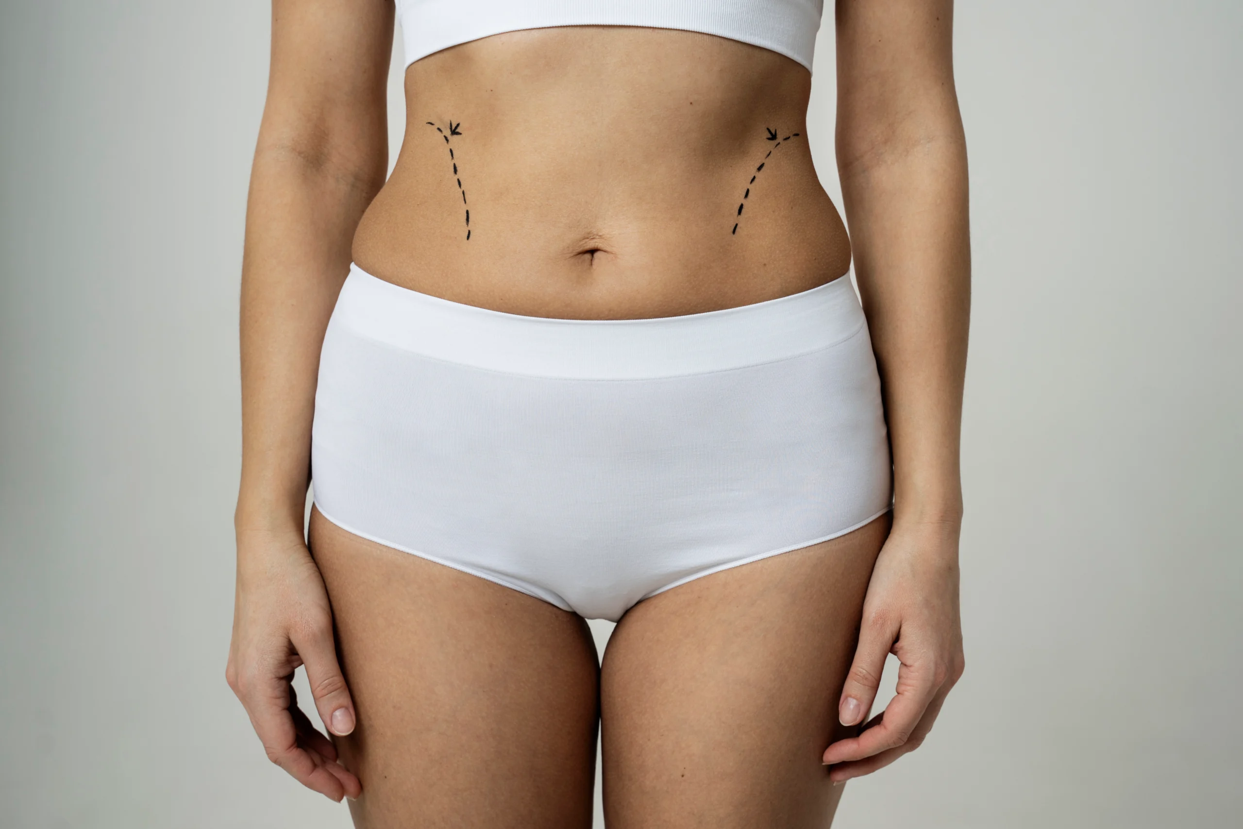 A cropped frontal view of a woman standing in white high-waisted briefs and a crop top, featuring black dashed lines and descending arrows on her waist flanks to map the incision borders for tummy tuck scar healing in UK.