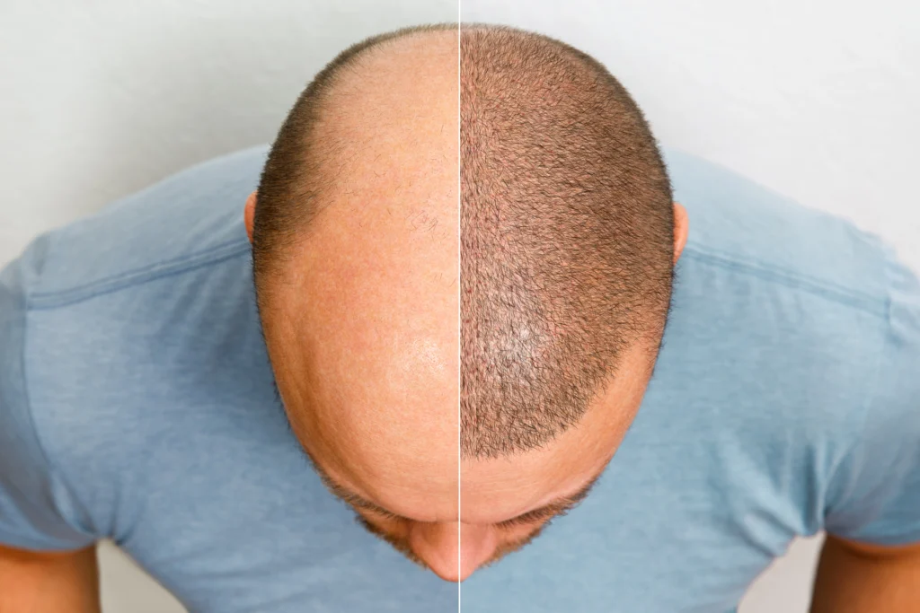 A top-down split comparison image showing a male patient's scalp with extensive hair loss on the left, and thick, short hair growth following a successful hair transplant on the right, illustrating the surgical results of FUT vs FUE surgery in uk.