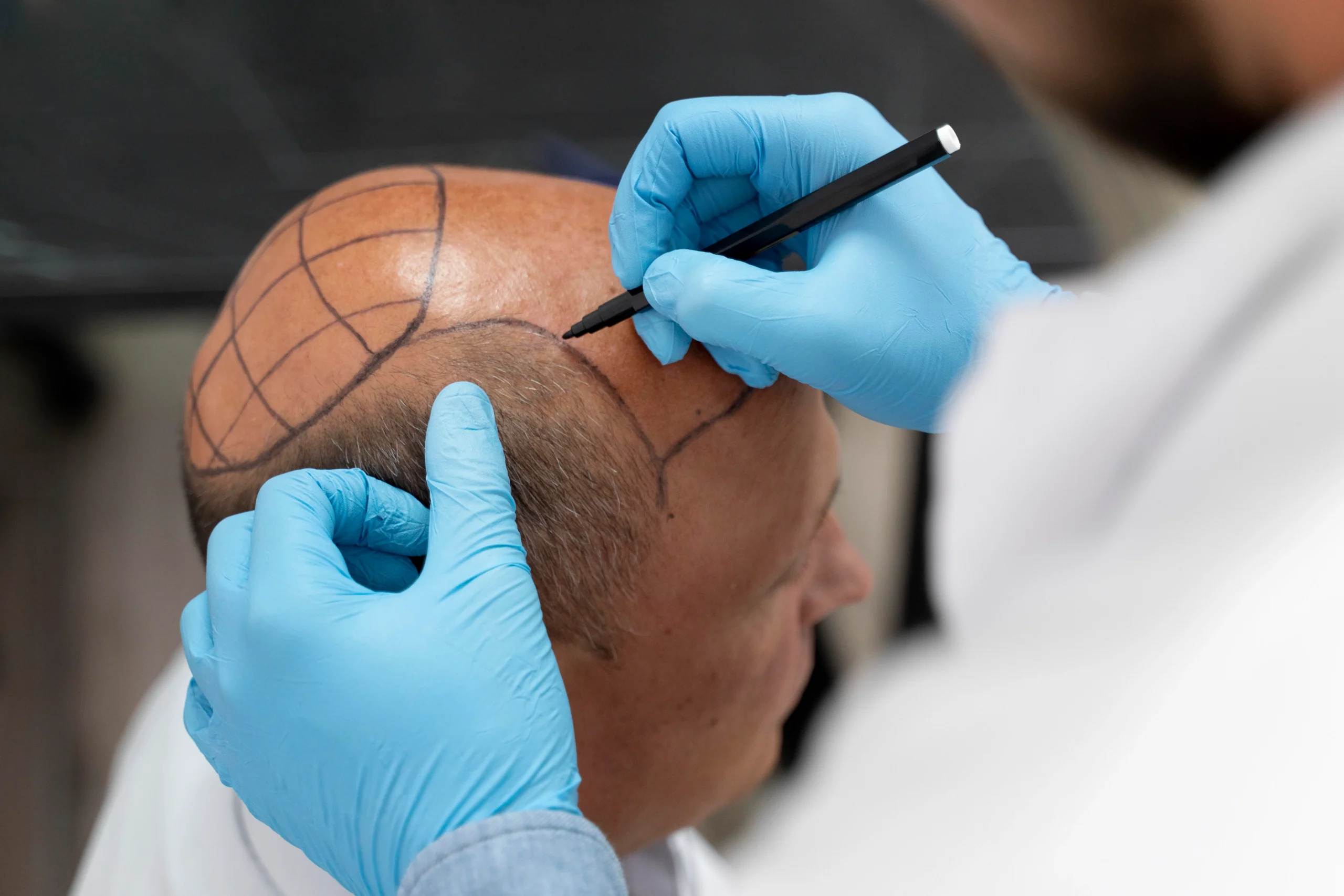 A close-up view of a surgeon wearing blue gloves using a black marker to draw a structural grid template on a male patient's balding scalp for FUT vs FUE surgery in uk planning.