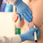A detailed close-up side view of a patient during a consultation, where a surgeon wearing blue sterile gloves is using a black surgical marker to draw precise preoperative planning lines on her breast to outline incision and pocket placement for fast-track breast surgery.
