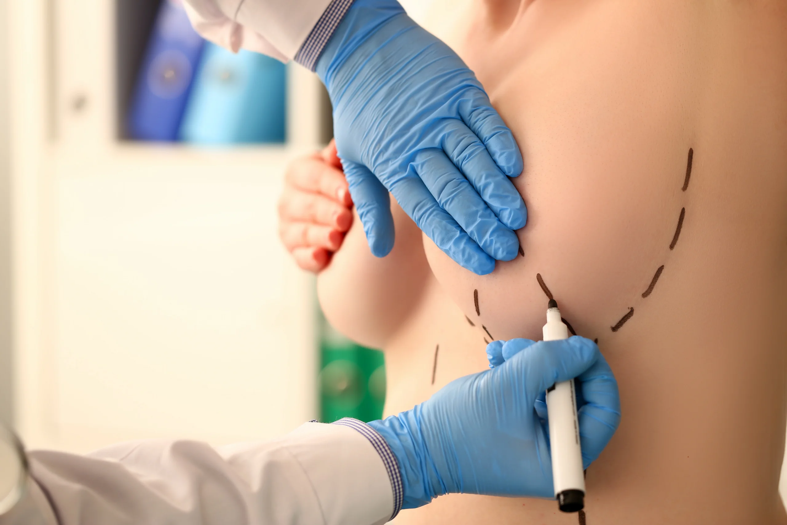 A detailed close-up side view of a patient during a consultation, where a surgeon wearing blue sterile gloves is using a black surgical marker to draw precise preoperative planning lines on her breast to outline incision and pocket placement for fast-track breast surgery.