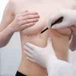A close-up frontal clinical view of a patient’s torso during a preoperative assessment, with a plastic surgeon wearing white sterile gloves using a black surgical marker to draw precise dashed lines along the inframammary fold to plan a Breast lift surgery UK.