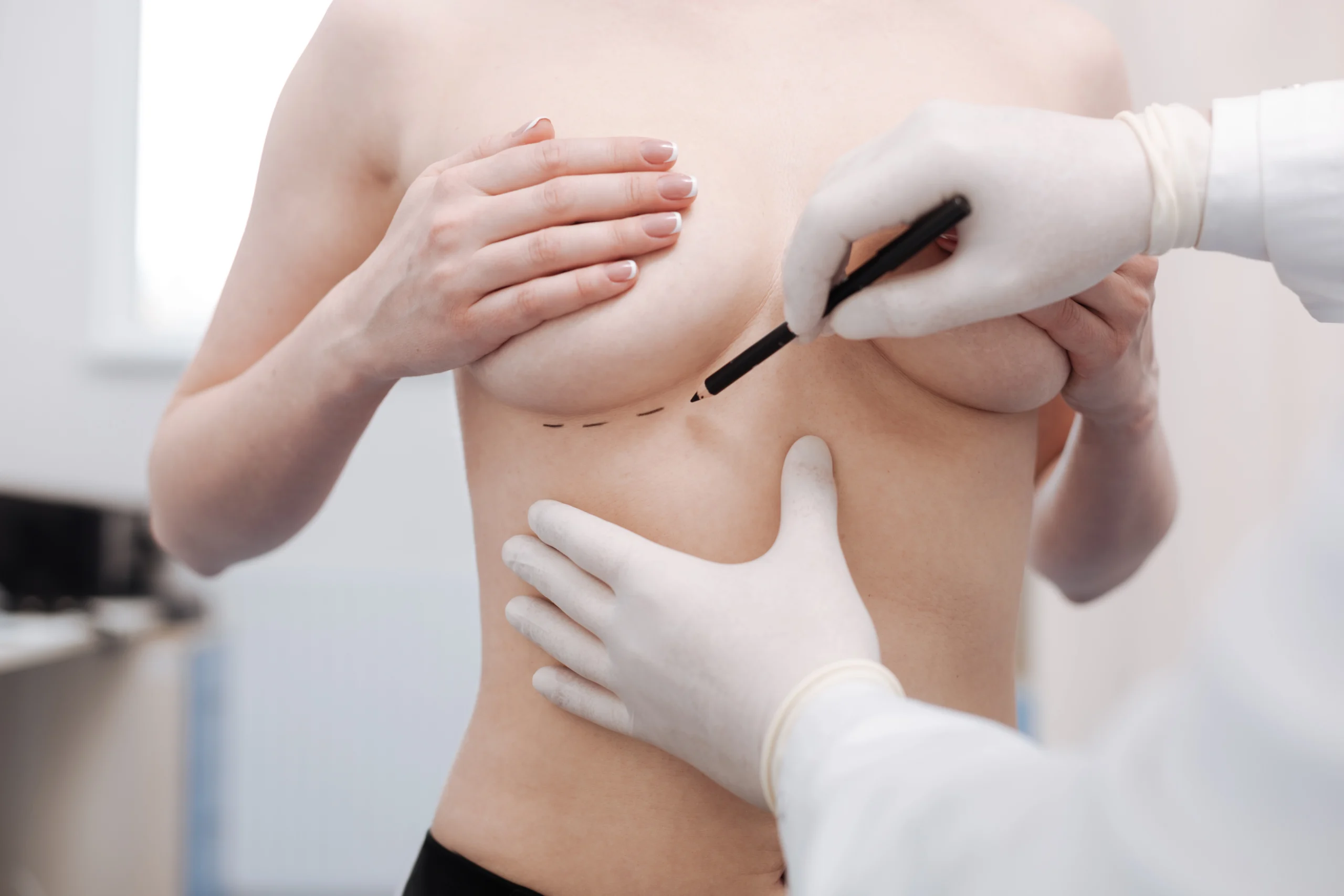 A close-up frontal clinical view of a patient’s torso during a preoperative assessment, with a plastic surgeon wearing white sterile gloves using a black surgical marker to draw precise dashed lines along the inframammary fold to plan a Breast lift surgery UK.