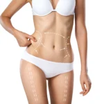 A detailed close-up frontal view of a woman’s torso in white underwear against a white background, pinching localized adipose tissue on her flank while white vector arrows and dashed lines map out surgical sculpting zones prior to seeking the Best Liposuction UK.
