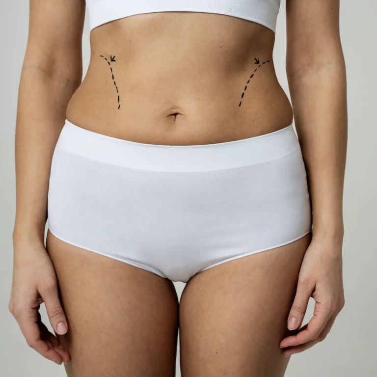 A cropped frontal view of a woman standing in white high-waisted briefs and a crop top, featuring black dashed lines and descending arrows on her waist flanks to map the incision borders for tummy tuck scar healing in UK.