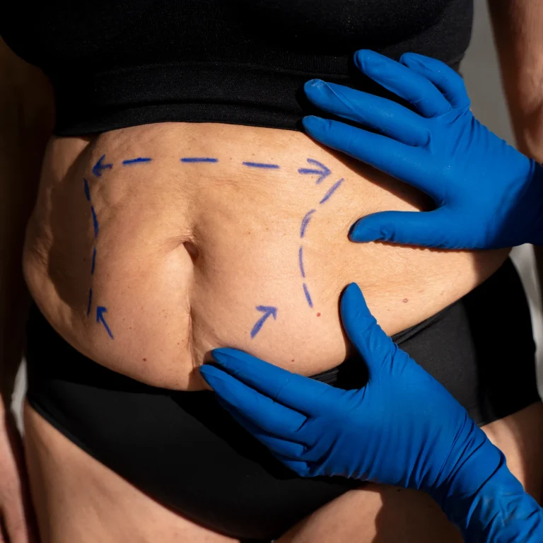 A posterior view of a woman's torso and upper thighs in white underwear against a pink background, featuring white dashed planning lines and directional arrows to map out localized fat extraction for an instructive guide to Understand 360 Liposuction Recovery Day By Day In UK.